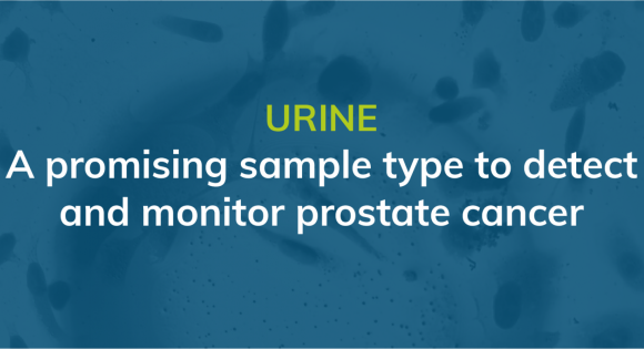 Urine: a promising sample type to detect and monitor prostate cancer